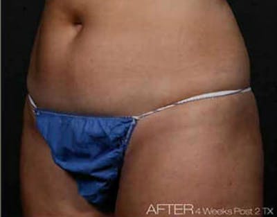 TruSculpt Before & After Gallery - Patient 9605782 - Image 2