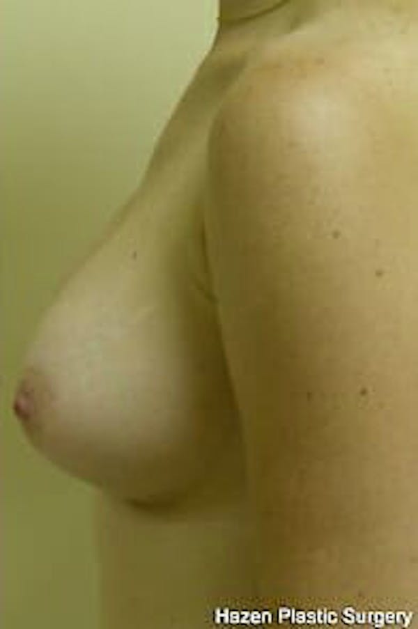 Breast Augmentation Before & After Gallery - Patient 9605783 - Image 6