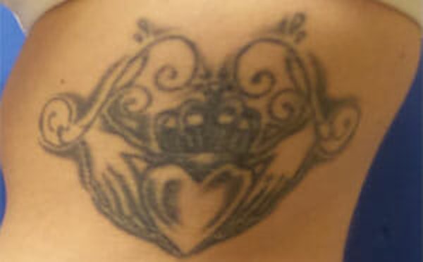 PicoSure Tattoo Removal