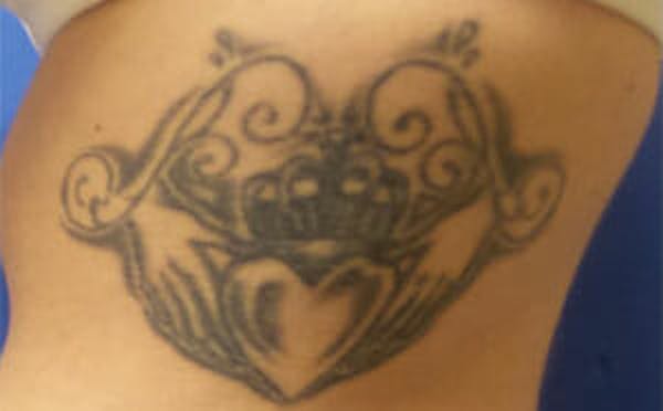 Tattoo Removal Before & After Gallery - Patient 9605786 - Image 1
