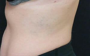 PicoSure Tattoo Removal