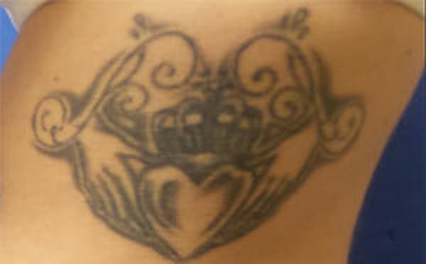 Tattoo Removal Before & After Gallery - Patient 9605786 - Image 3