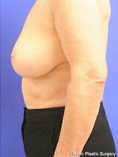 Breast Reduction Before & After Gallery - Patient 9605787 - Image 6