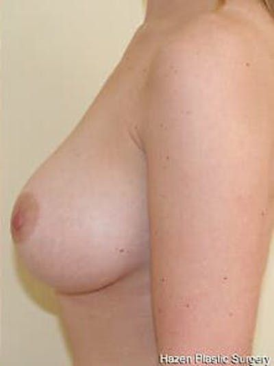 Breast Augmentation Before & After Gallery - Patient 9605788 - Image 6