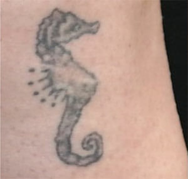 Tattoo Removal Before & After Gallery - Patient 9605789 - Image 1