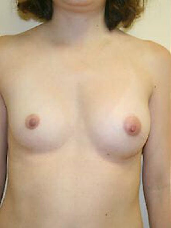 Breast Augmentation Before & After Gallery - Patient 9605791 - Image 1