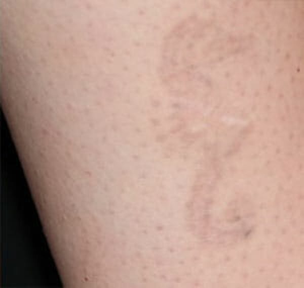 Tattoo Removal Before & After Gallery - Patient 9605789 - Image 2