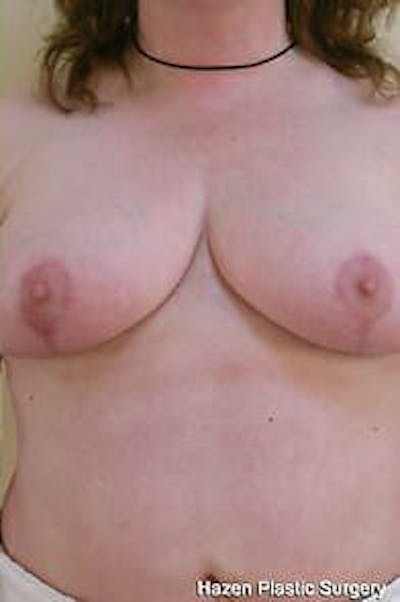 Breast Reduction Before & After Gallery - Patient 9605793 - Image 2