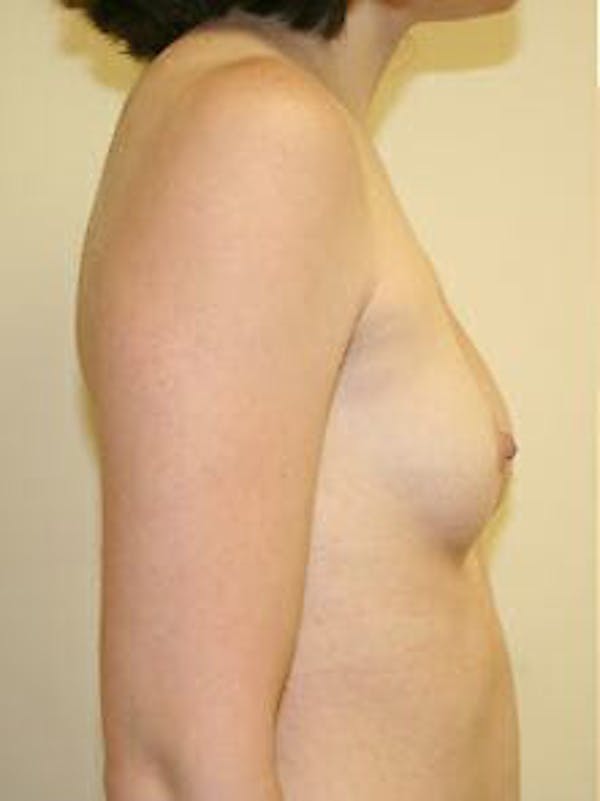 Breast Augmentation Before & After Gallery - Patient 9605791 - Image 5
