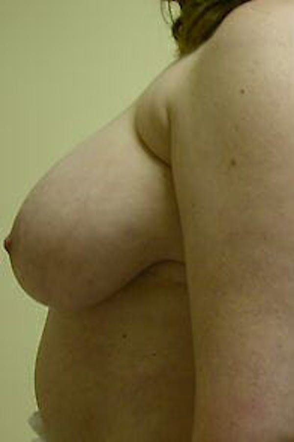 Breast Reduction Before & After Gallery - Patient 9605793 - Image 5