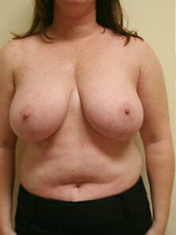 Breast Reduction Before & After Gallery - Patient 9605803 - Image 1