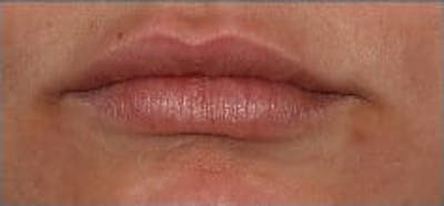 Restylane Refyne Before & After Gallery - Patient 9605794 - Image 1