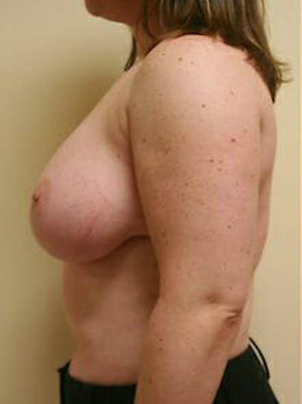 Breast Reduction Before & After Gallery - Patient 9605803 - Image 5