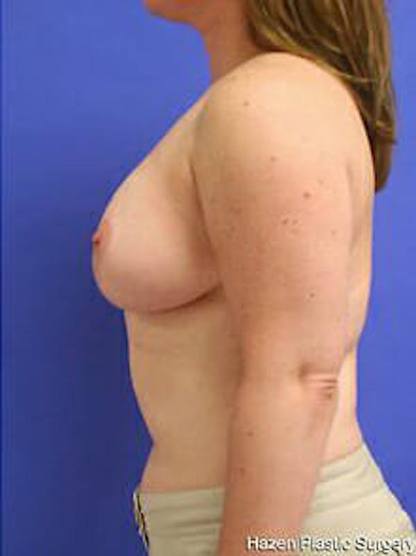 Breast Reduction Before & After Gallery - Patient 9605803 - Image 6