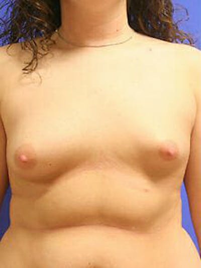 Breast Augmentation Before & After Gallery - Patient 9605806 - Image 1