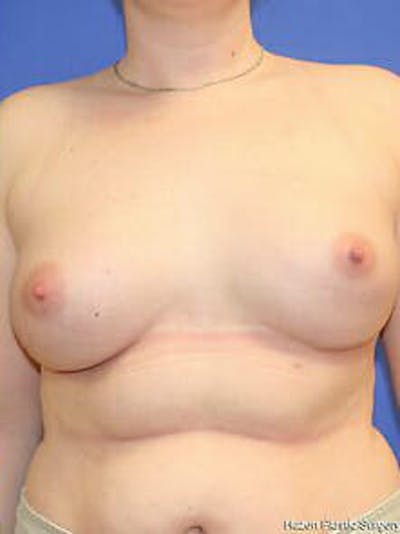 Breast Augmentation Before & After Gallery - Patient 9605806 - Image 2