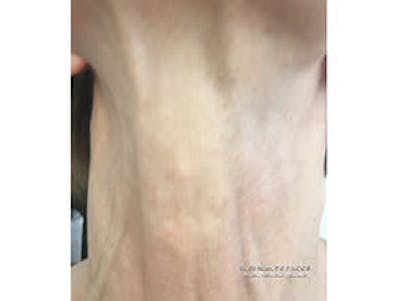Sciton BBL Before & After Gallery - Patient 9605804 - Image 2