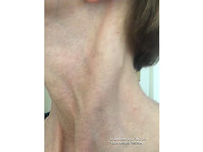 Sciton BBL Before & After Gallery - Patient 9605804 - Image 4