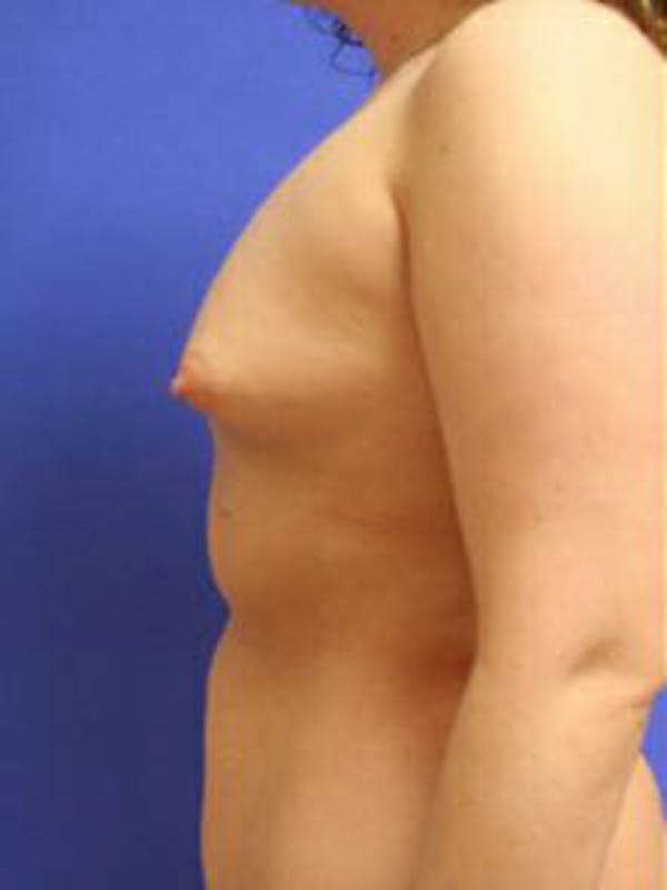 Breast Augmentation Before & After Gallery - Patient 9605806 - Image 5