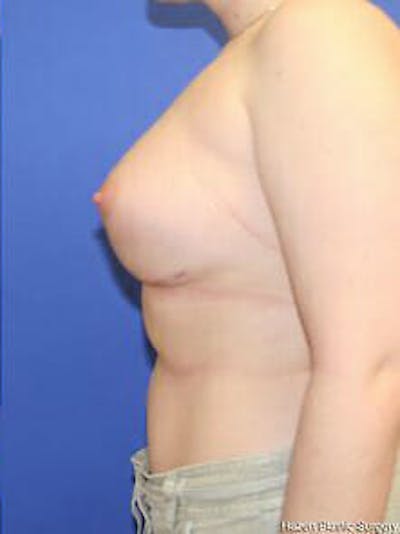 Breast Augmentation Before & After Gallery - Patient 9605806 - Image 6