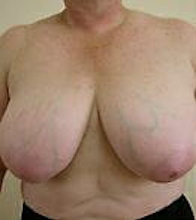 Breast Reduction Before & After Gallery - Patient 9605808 - Image 1