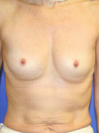 Breast Augmentation Before & After Gallery - Patient 9605811 - Image 1
