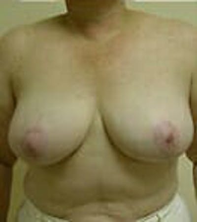 Breast Reduction Before & After Gallery - Patient 9605808 - Image 2