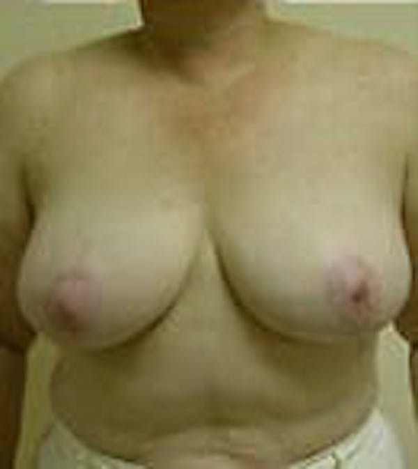 Breast Reduction Before & After Gallery - Patient 9605808 - Image 2