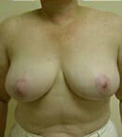 Breast Reduction Gallery - Patient 9605808 - Image 2
