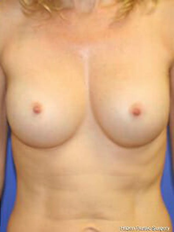 Breast Augmentation Before & After Gallery - Patient 9605811 - Image 2
