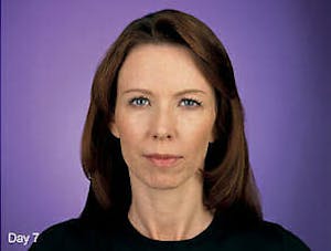 botox before and after photos