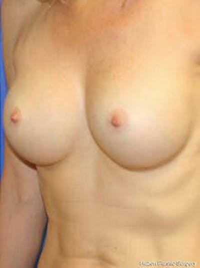 Breast Augmentation Before & After Gallery - Patient 9605811 - Image 4