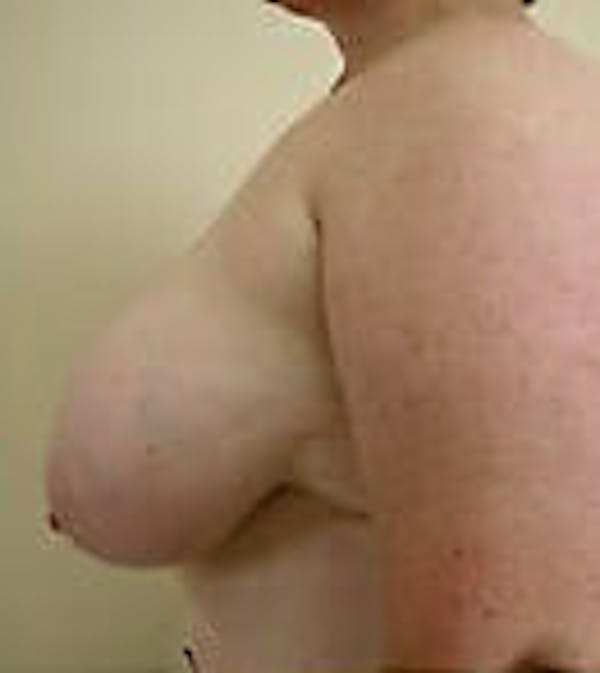 Breast Reduction Before & After Gallery - Patient 9605808 - Image 5