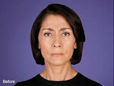 Botox Before & After Gallery - Patient 9605809 - Image 1