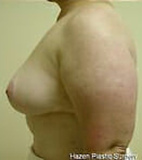 Breast Reduction Before & After Gallery - Patient 9605808 - Image 6