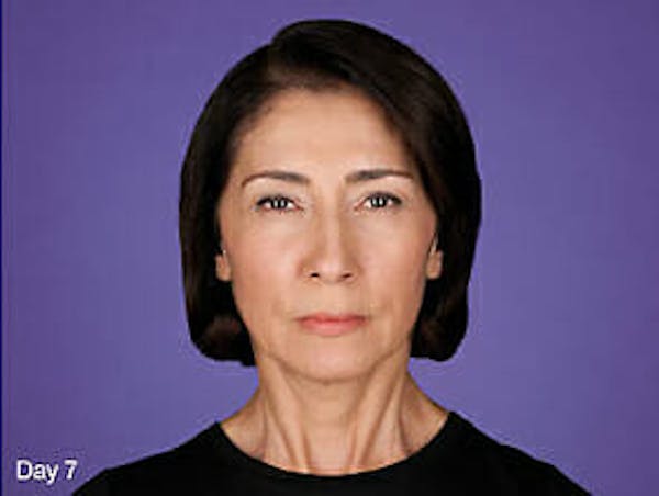 Botox Before & After Gallery - Patient 9605809 - Image 2