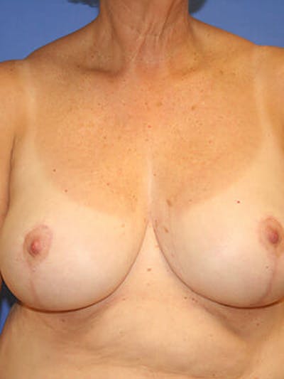 Breast Reduction Before & After Gallery - Patient 9605813 - Image 2