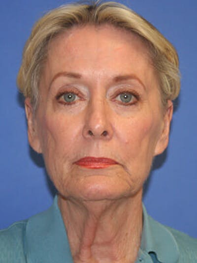 Facelift Before & After Gallery - Patient 9605815 - Image 1