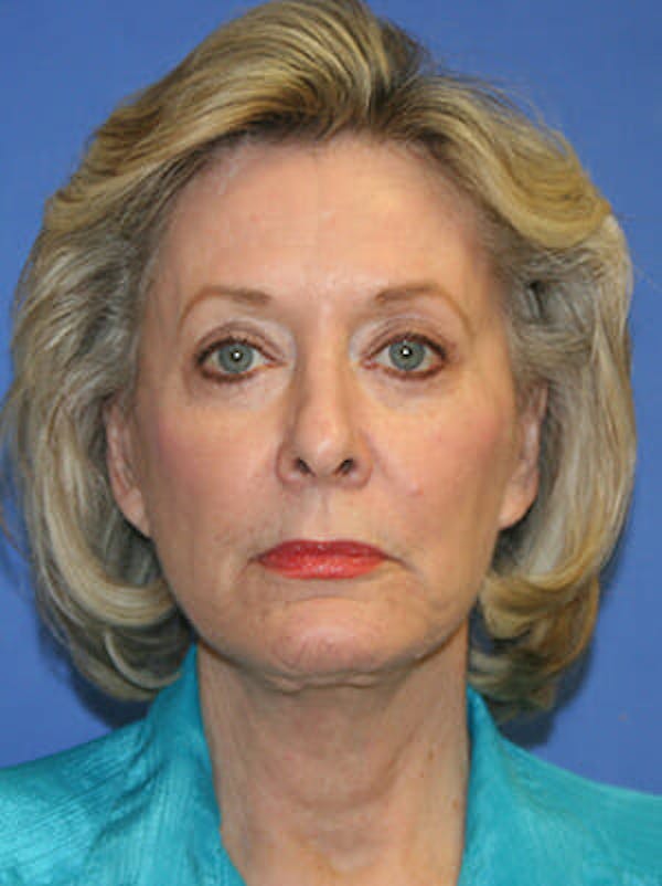 Facelift Before & After Gallery - Patient 9605815 - Image 2