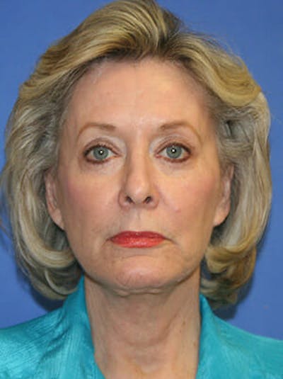 Facelift Before & After Gallery - Patient 9605815 - Image 2