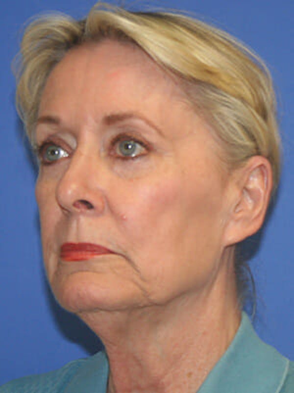 Facelift Before & After Gallery - Patient 9605815 - Image 3