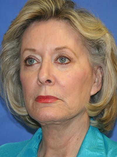 Facelift Before & After Gallery - Patient 9605815 - Image 4