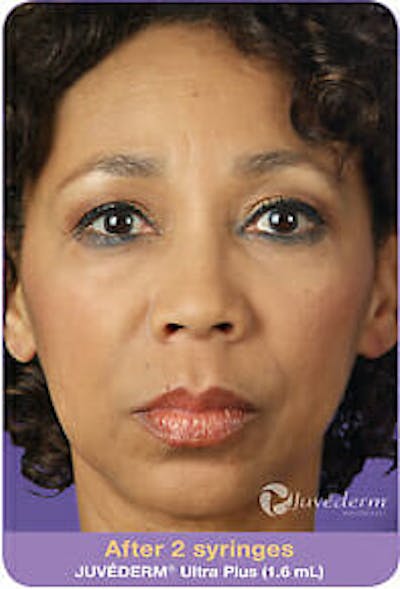 Juvederm Before & After Gallery - Patient 9605814 - Image 2