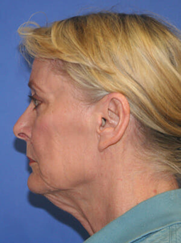 Facelift Before & After Gallery - Patient 9605815 - Image 5