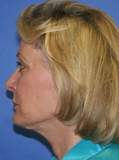 Facelift Before & After Gallery - Patient 9605815 - Image 6
