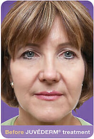 Juvederm Before & After Gallery - Patient 9605817 - Image 1