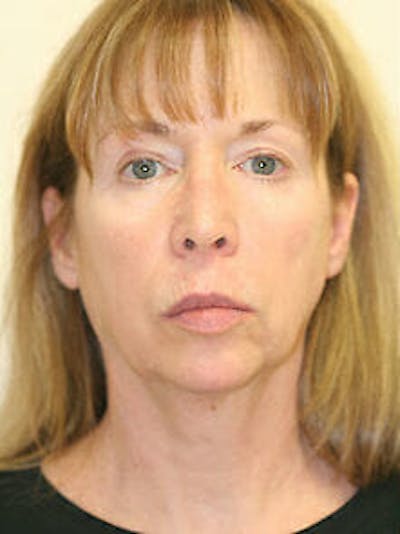 Facelift Before & After Gallery - Patient 9605823 - Image 1