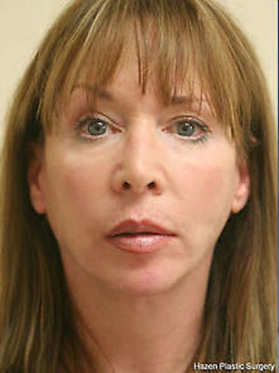 Facelift Before & After Gallery - Patient 9605823 - Image 2