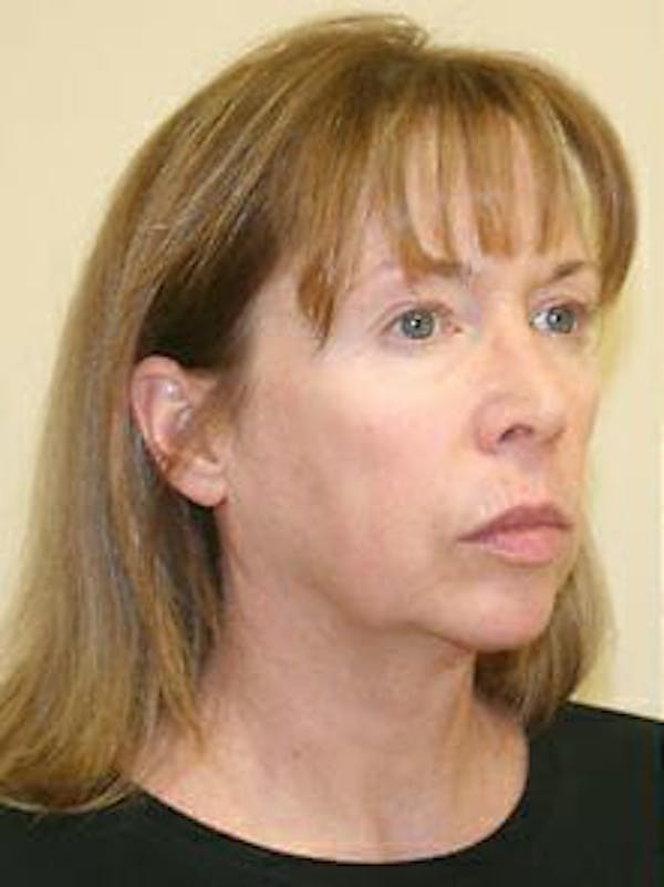 Facelift Before & After Gallery - Patient 9605823 - Image 3