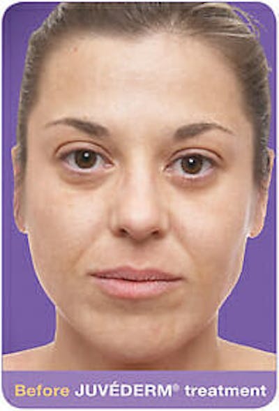 Juvederm Before & After Gallery - Patient 9605818 - Image 1